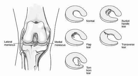 de soorten meniscus scheur